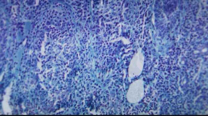 3,000-doses-of-the-monkeypox-vaccine-arrive-in-ga