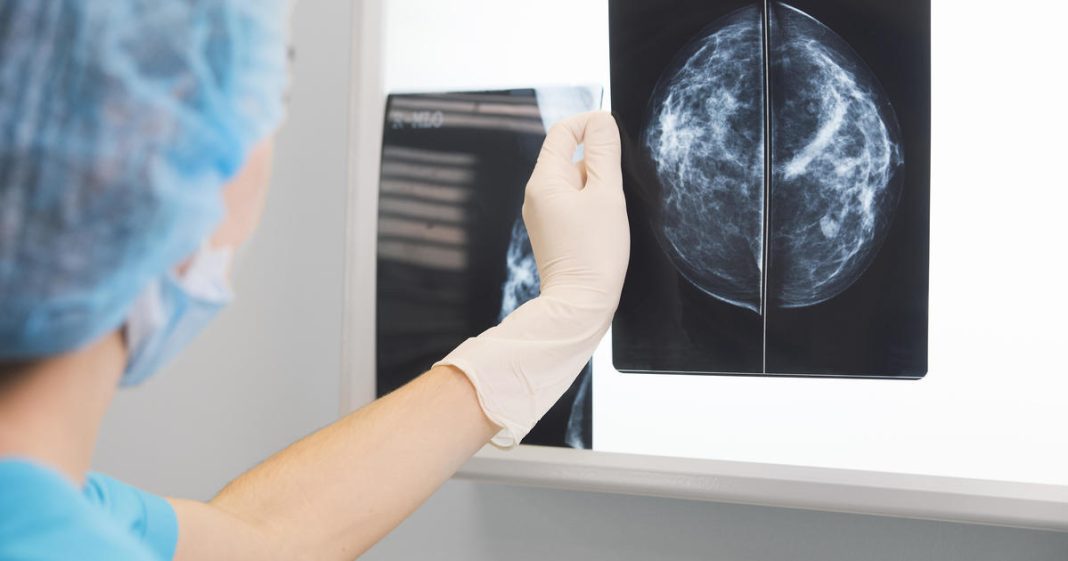 mammography-ai-can-cost-patients-extra.-is-it-worth-it?